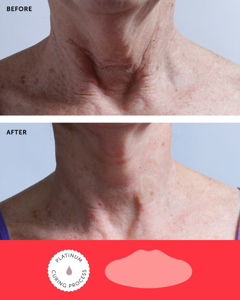 Silcskin Collette neck silicone patch used in a consistent skincare routine to smooth fine lines